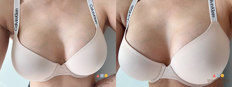 수술 후