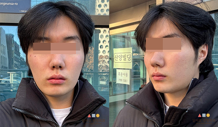 수술 전
