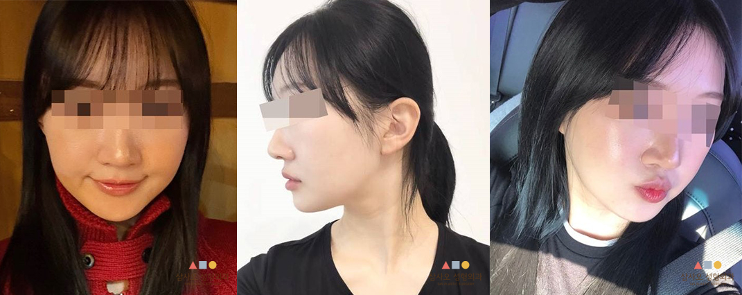 수술 후