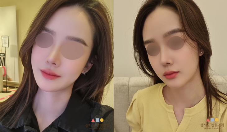 수술 후