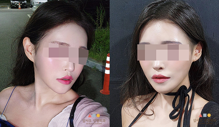 수술 후
