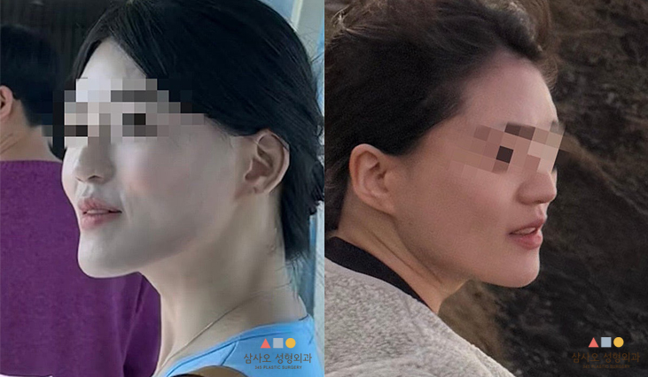 수술 전