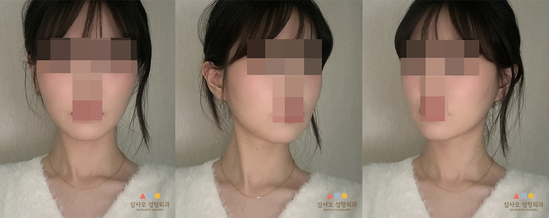 수술 후