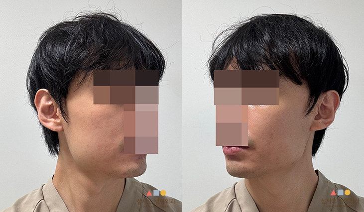 수술 전