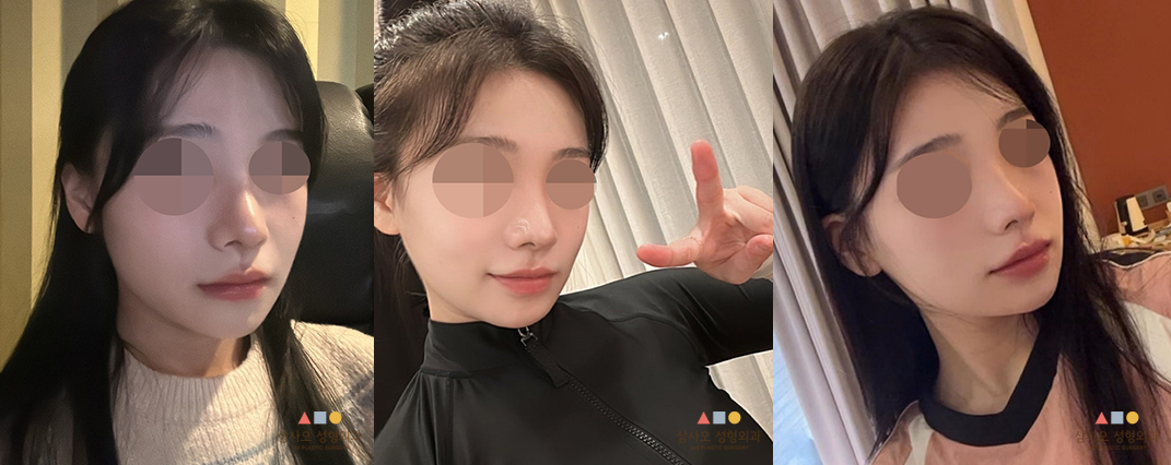 수술 후
