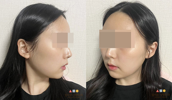 수술 후