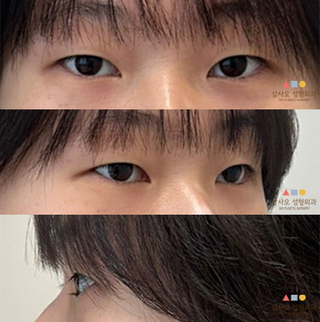 수술 전