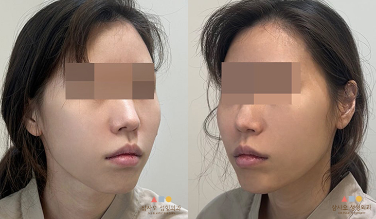 수술 전