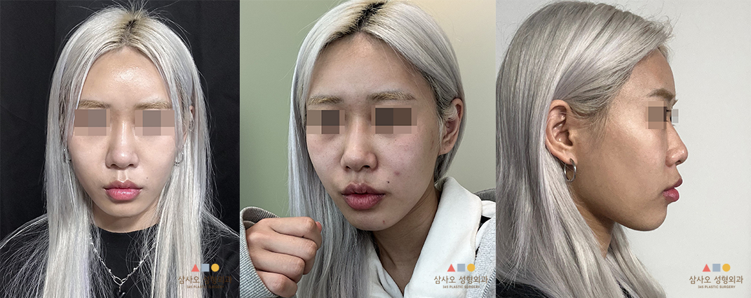 수술 전