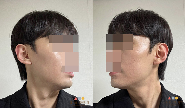수술 후