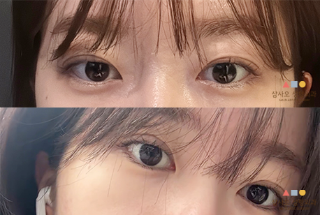 수술 후
