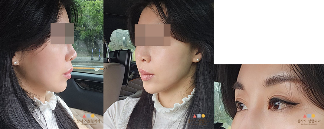 수술 후