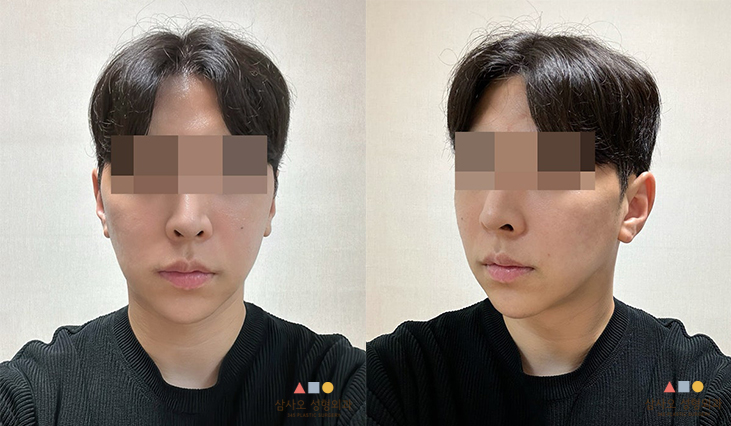 수술 후