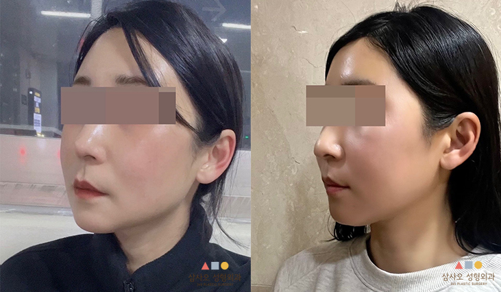 수술 후