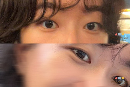 수술 전
