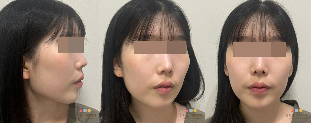 수술 전