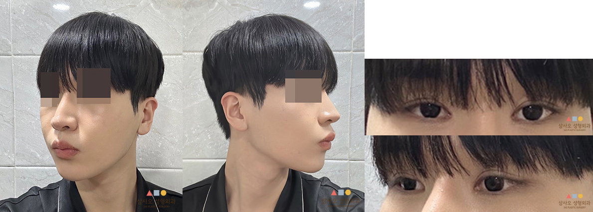 수술 후