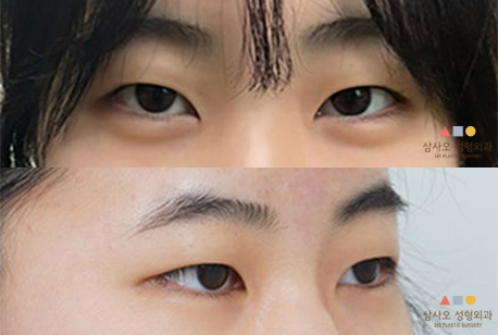 수술 전