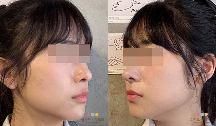 수술 후