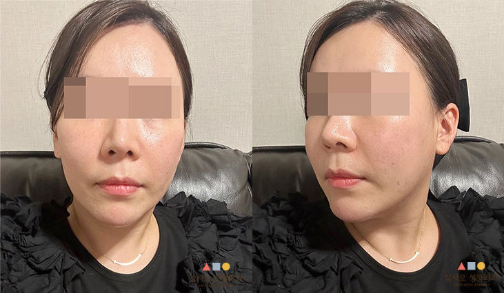 수술 후