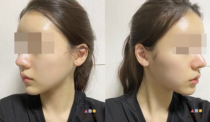수술 후