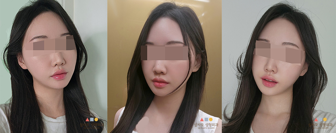 수술 후