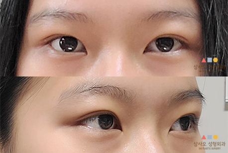 수술 후
