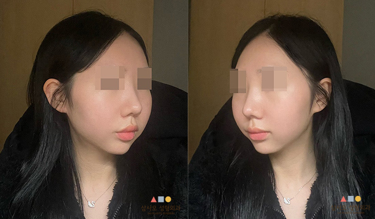 수술 후