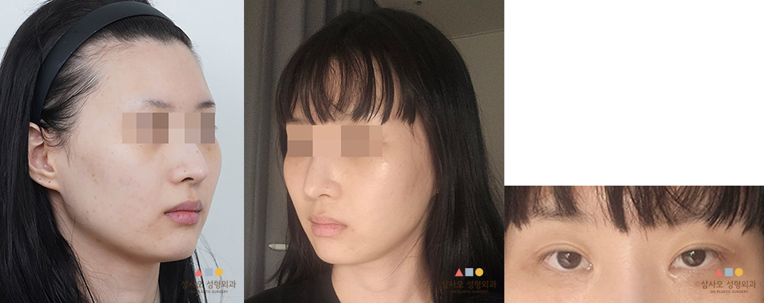 수술 전