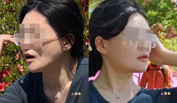 수술 후