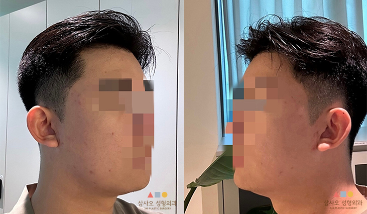 수술 전