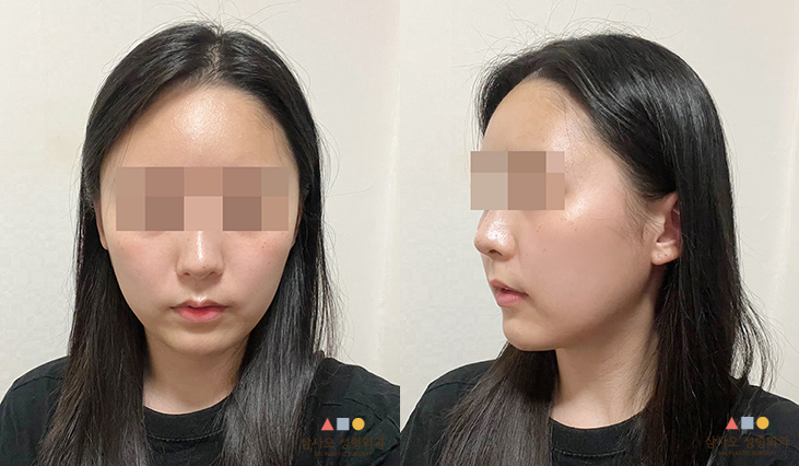 수술 후