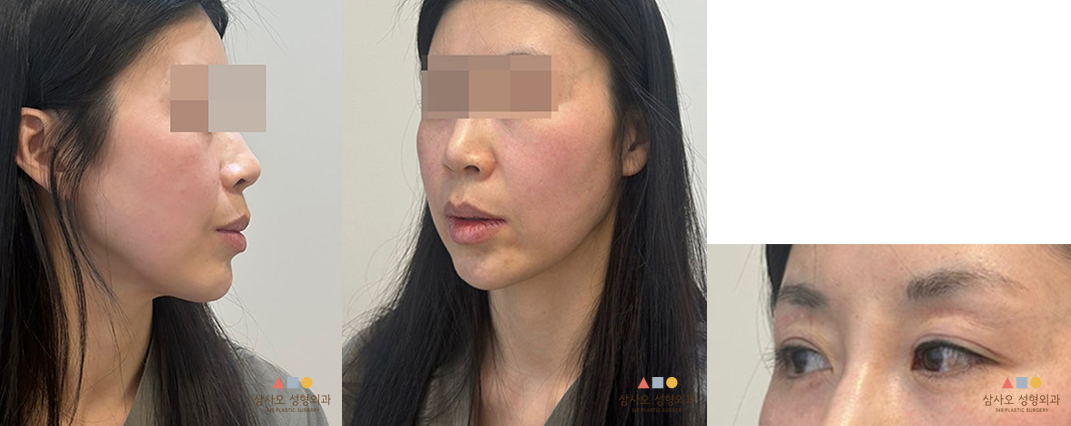 수술 전