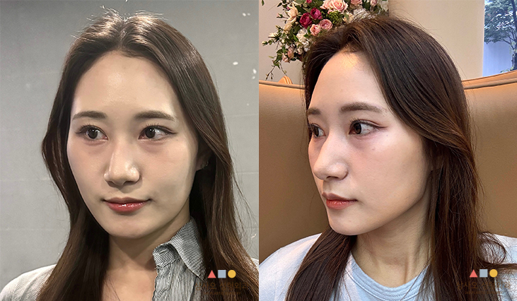 수술 전