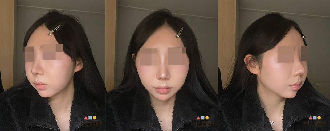 수술 후