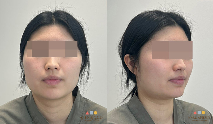 수술 전