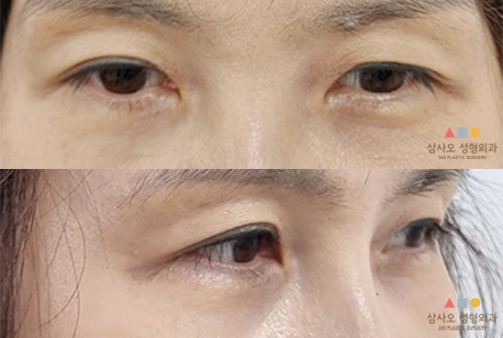 수술 후