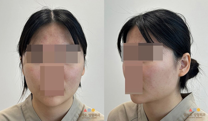 수술 전