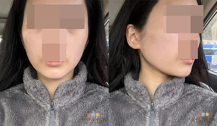 수술 후