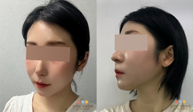 수술 후