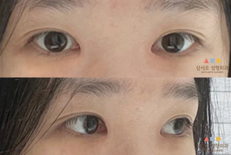 수술 후