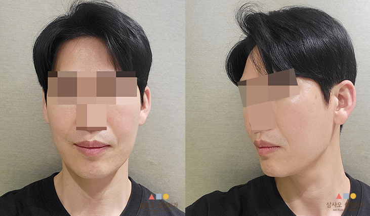수술 후