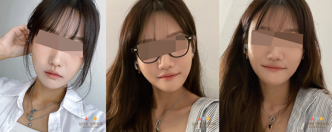 수술 후