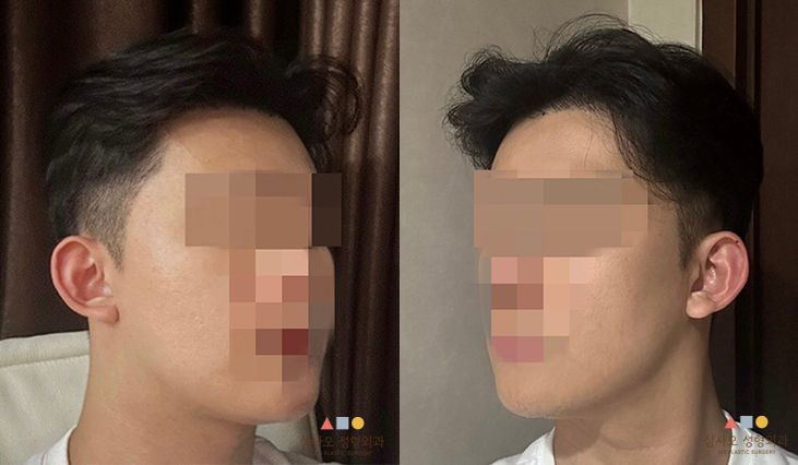 수술 후