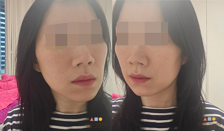 수술 전
