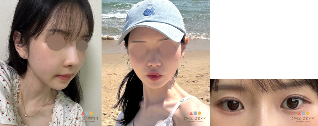 수술 후