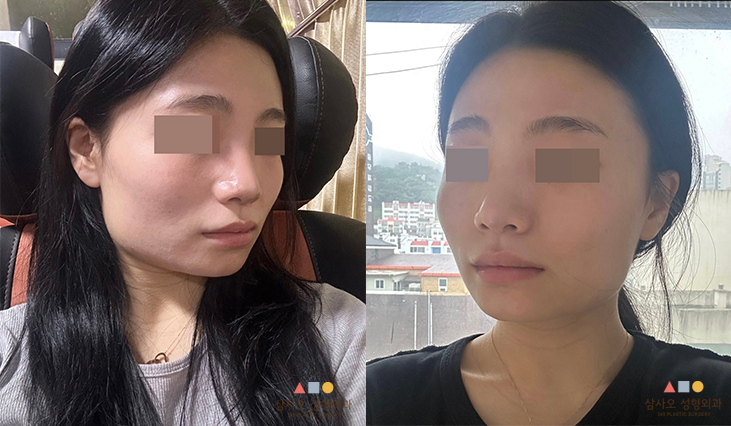 수술 전