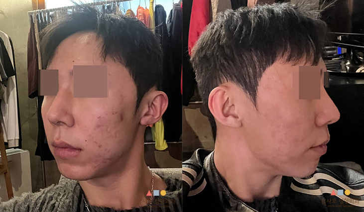 수술 후