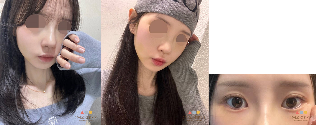 수술 후