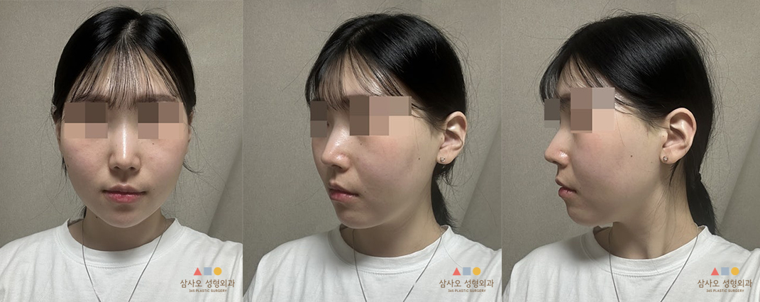 수술 후